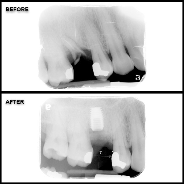 implant before and after