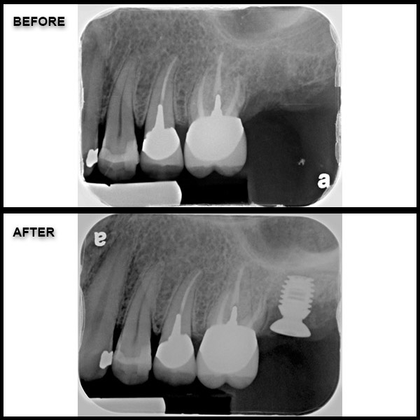 implant before and after